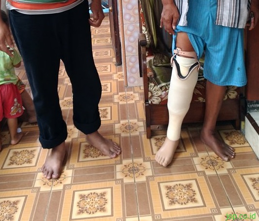5 Latihan untuk Orang yang Baru Diamputasi