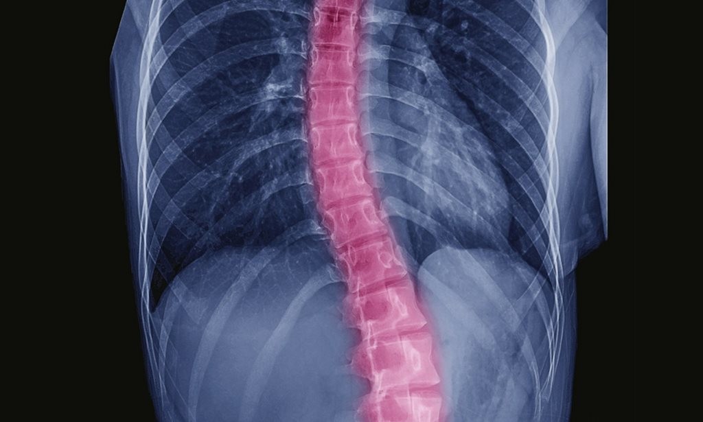 Semakin Cepat Semakin Mudah Menangani Skoliosis Ringan