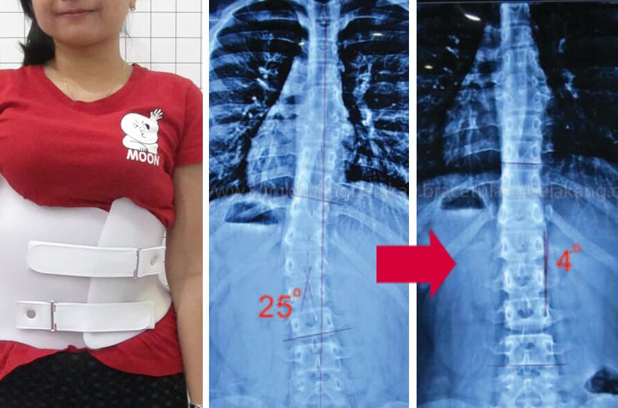 Apa Manfaat Memakai Back Brace Khususnya Korset TLSO?