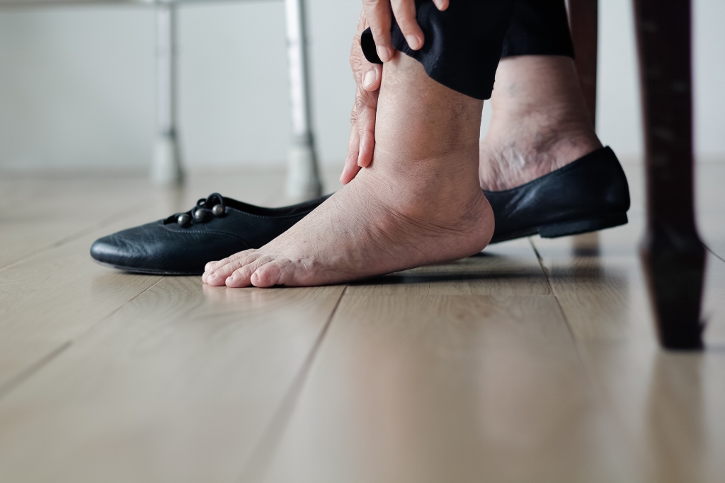 Kenali Gejala dan Penyebab Neuropati Diabetik atau Diabetic Foot