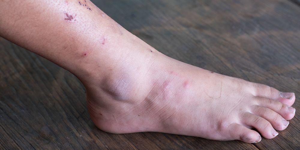 Cara Mengelola Komplikasi Kaki Diabetes oleh Spesialis Jual Kaki dan Tangan Palsu Denpasar Terbaik