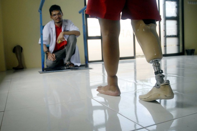 Nyeri Amputasi? Ini Kata yang Jual Tangan dan Kaki Palsu Bandar Lampung Terlengkap