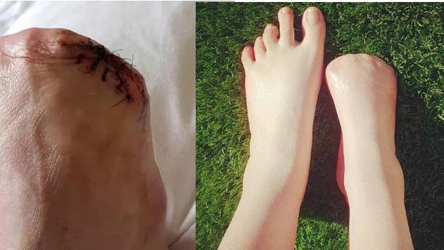Penyebab Hilangnya Anggota Badan dari yang Jual Jari Kaki dan Tangan Palsu Jayapura Terpopuler