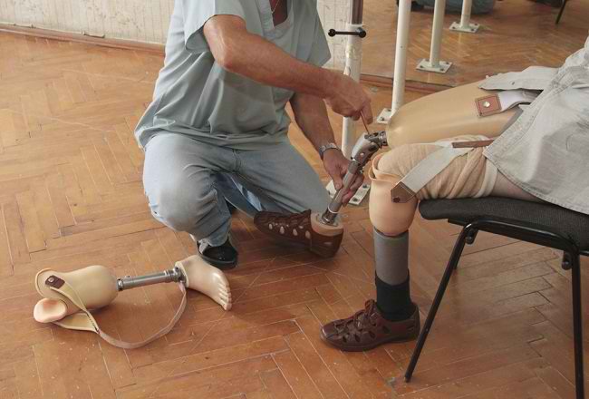 Wajib Diketahui untuk Pengguna Baru Alat Bantu Kaki Palsu dan Proses Pemasangannya